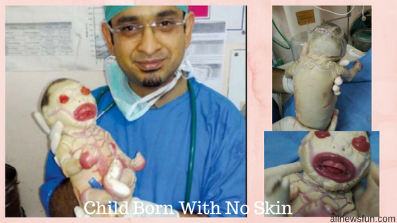 Baby born without skin in india